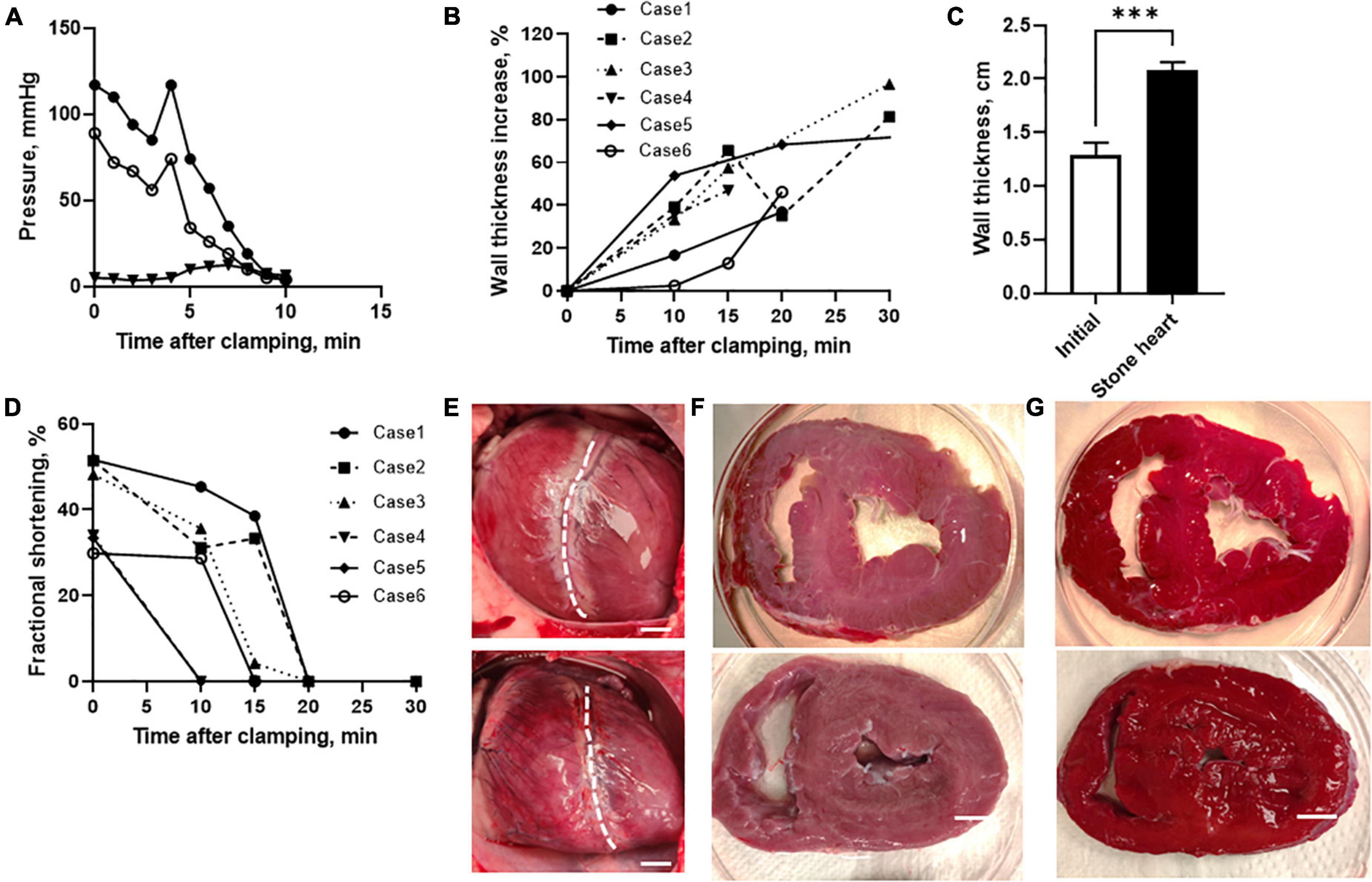 Development and prevention of ischemic contracture (“stone heart”) in the pig heart